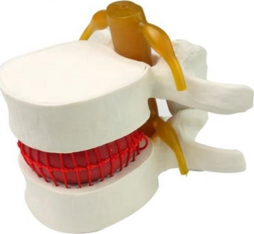 Disk Hernisi Fıtık Maketi Model 2